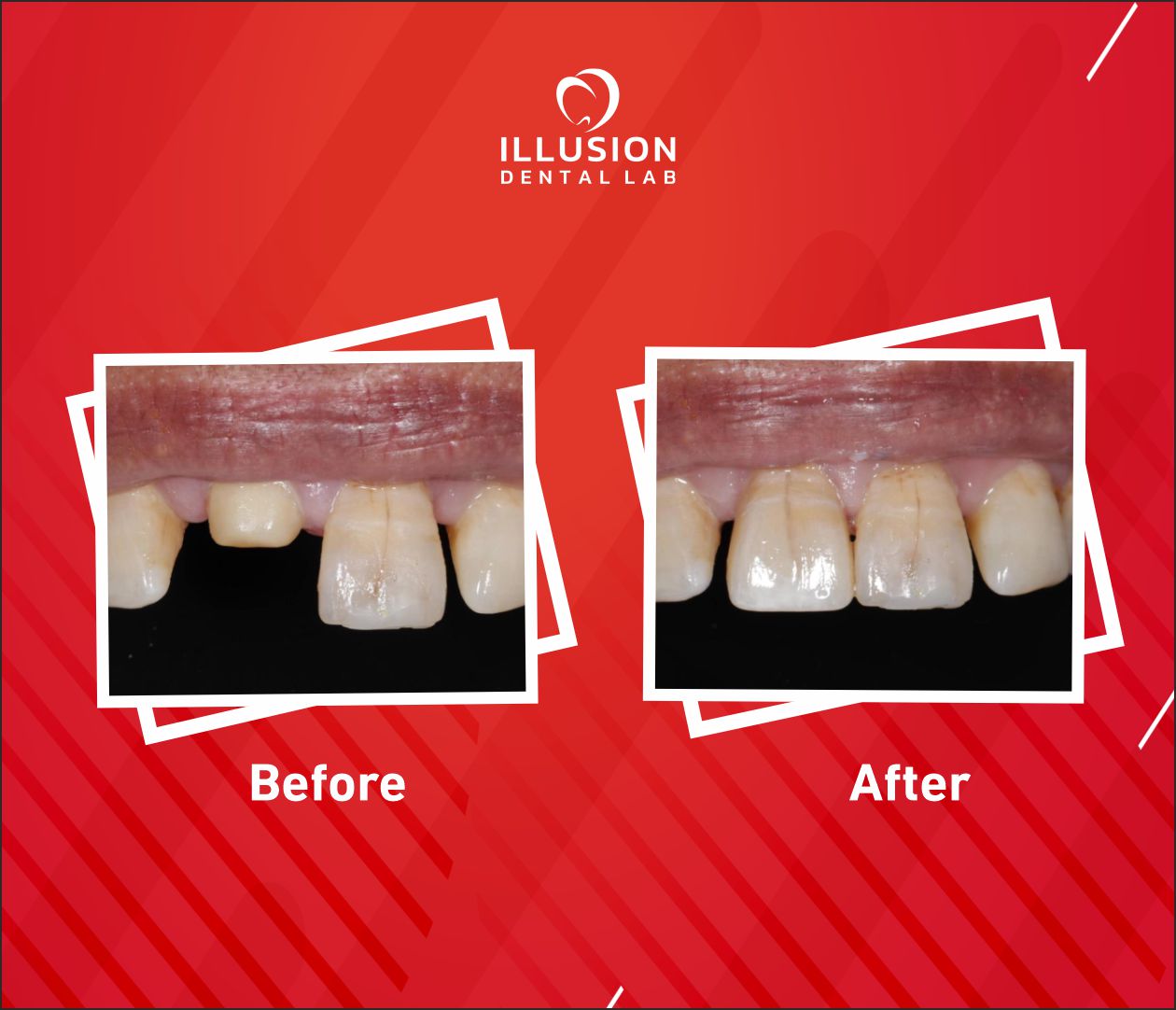 zirconia crown for anterior teeth